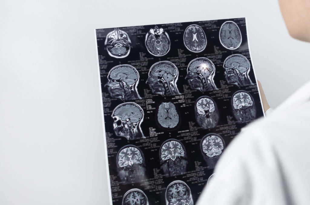 brain injury